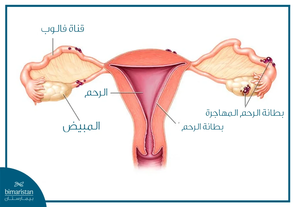 سم طبي يوضح وجود بطانة الرحم المهاجرة داخل الرحم وعلى المبيضين وقناتي فالوب مع توضيح البنية الداخلية للرحم.
