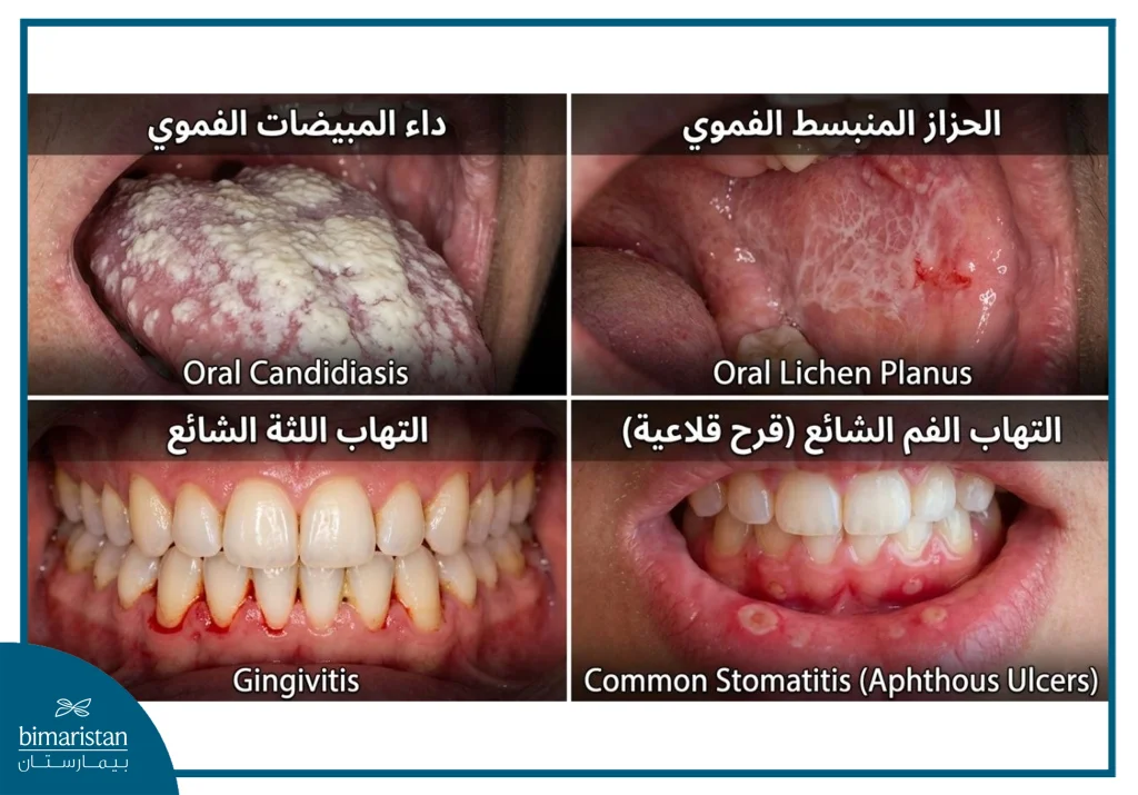 صورة تظهر أنواع مختلفة من تقرحات الفم