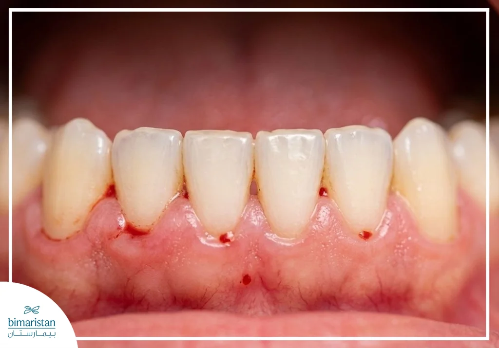 صورة تظهر نزيف اللثة والتهابها