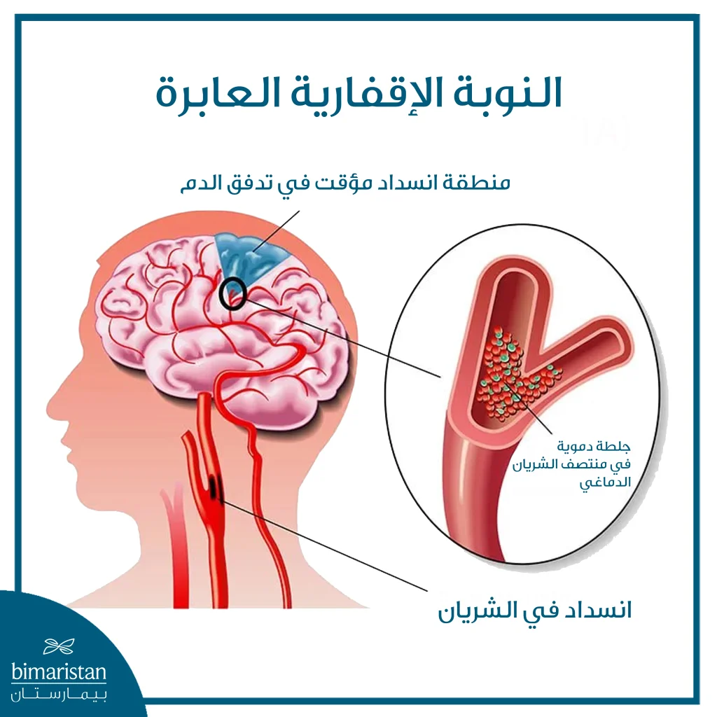 صورة تُظهر آلية حدوث النوبة الإقفارية العابرة