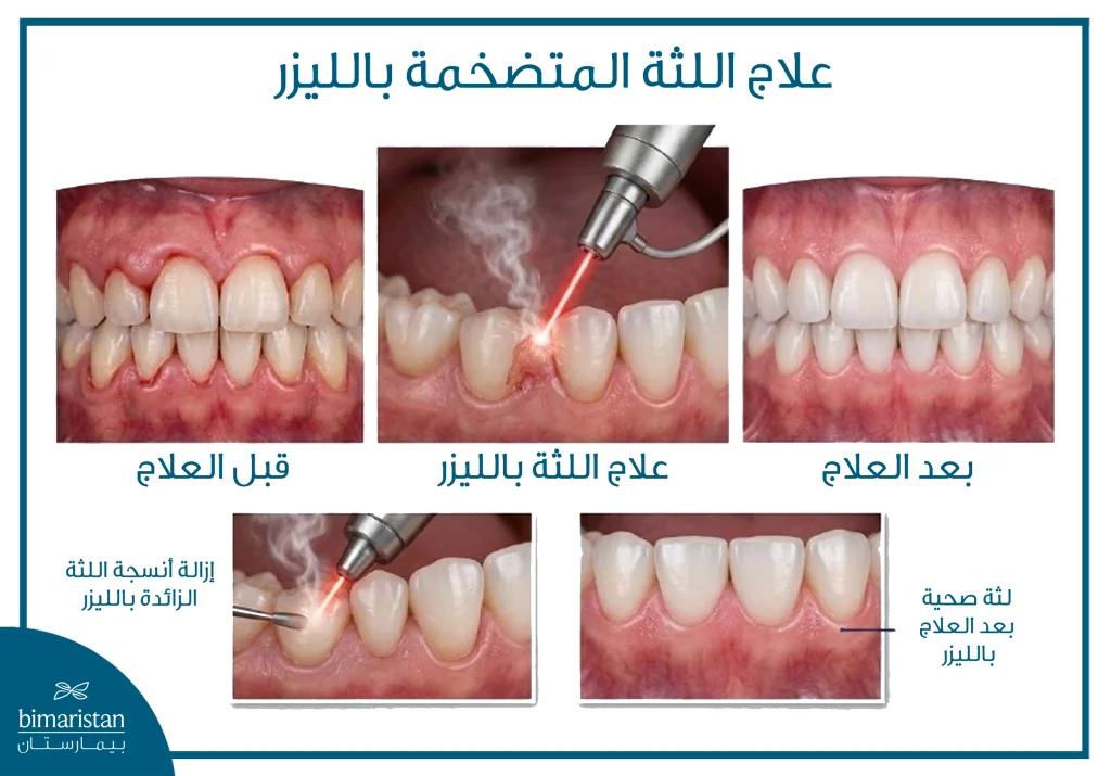 علاج اللثة المتضخمة بالليزر