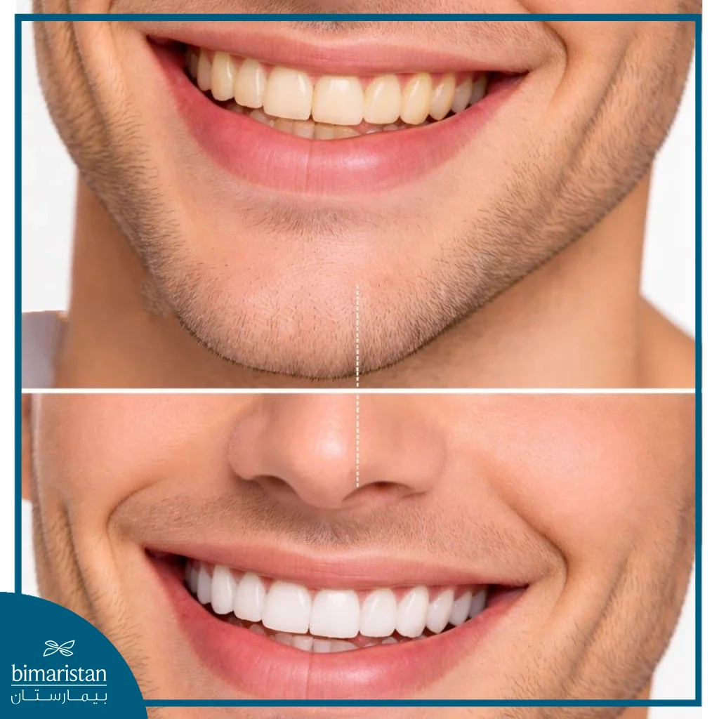 قبل وبعد ابتسامة هوليوود