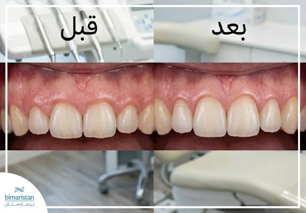 قبل وبعد تجميل اللثة بالليزر
