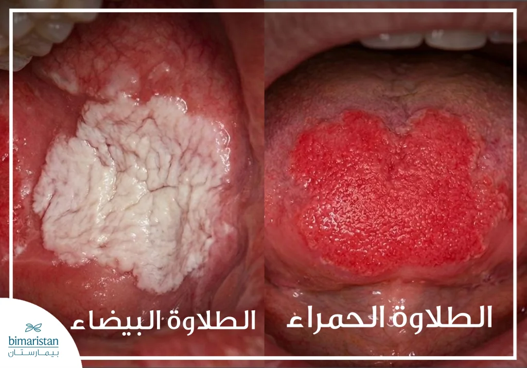 الطلاوة الحمراء الطلاوة البيضاء
