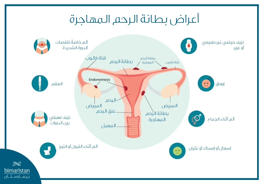 مخطط يوضح أعراض بطانة الرحم المهاجرة وتأثيرها على الرحم والمبيضين وقناتي فالوب.