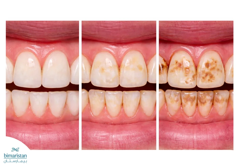 مراحل التصبغ المتدرجة خفيفة ومتوسطة وشديدة