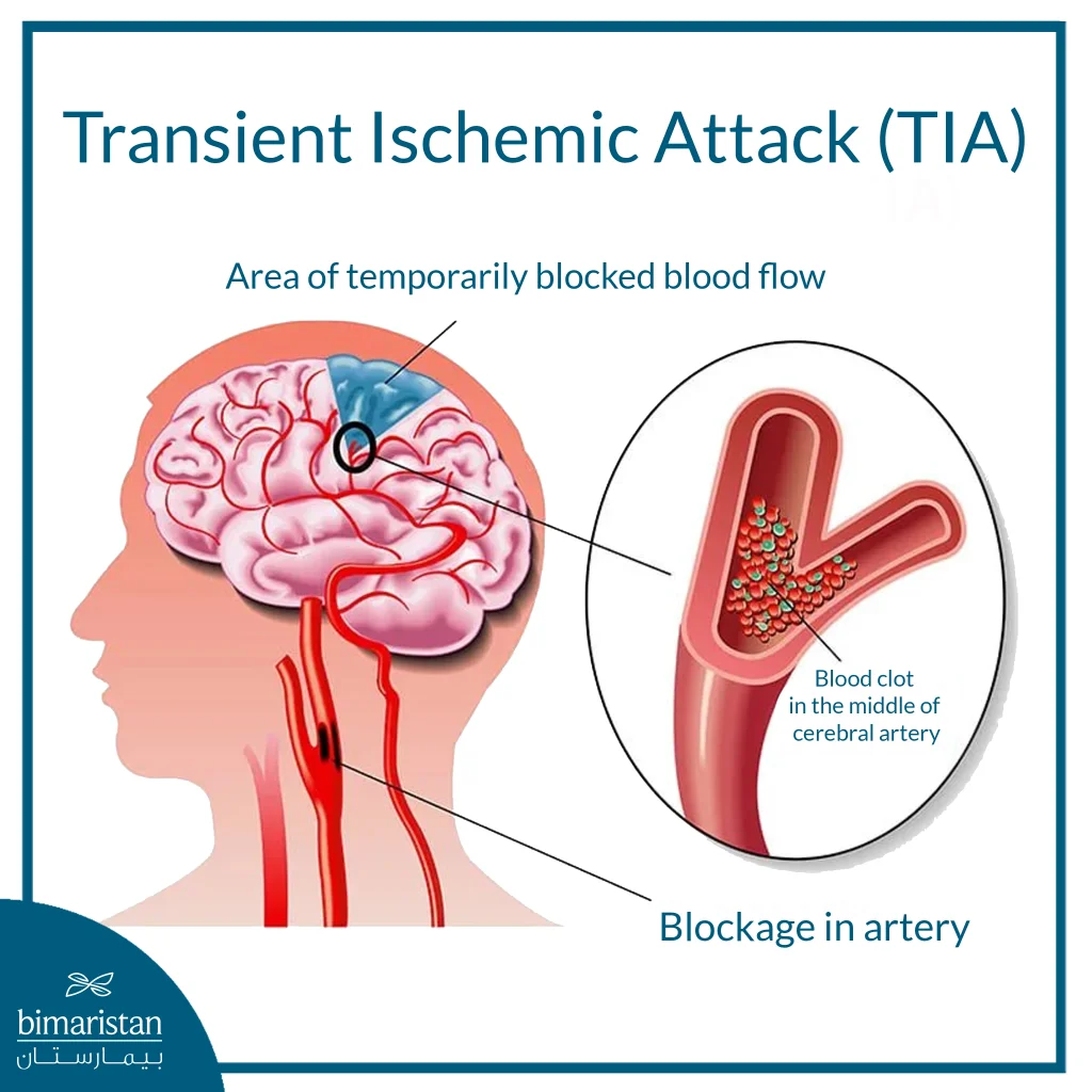 Transient Ischemic Attack: Causes, Symptoms, And Treatment Options 3 An Image Illustrating The Mechanism Of A Transient Ischemic Attack