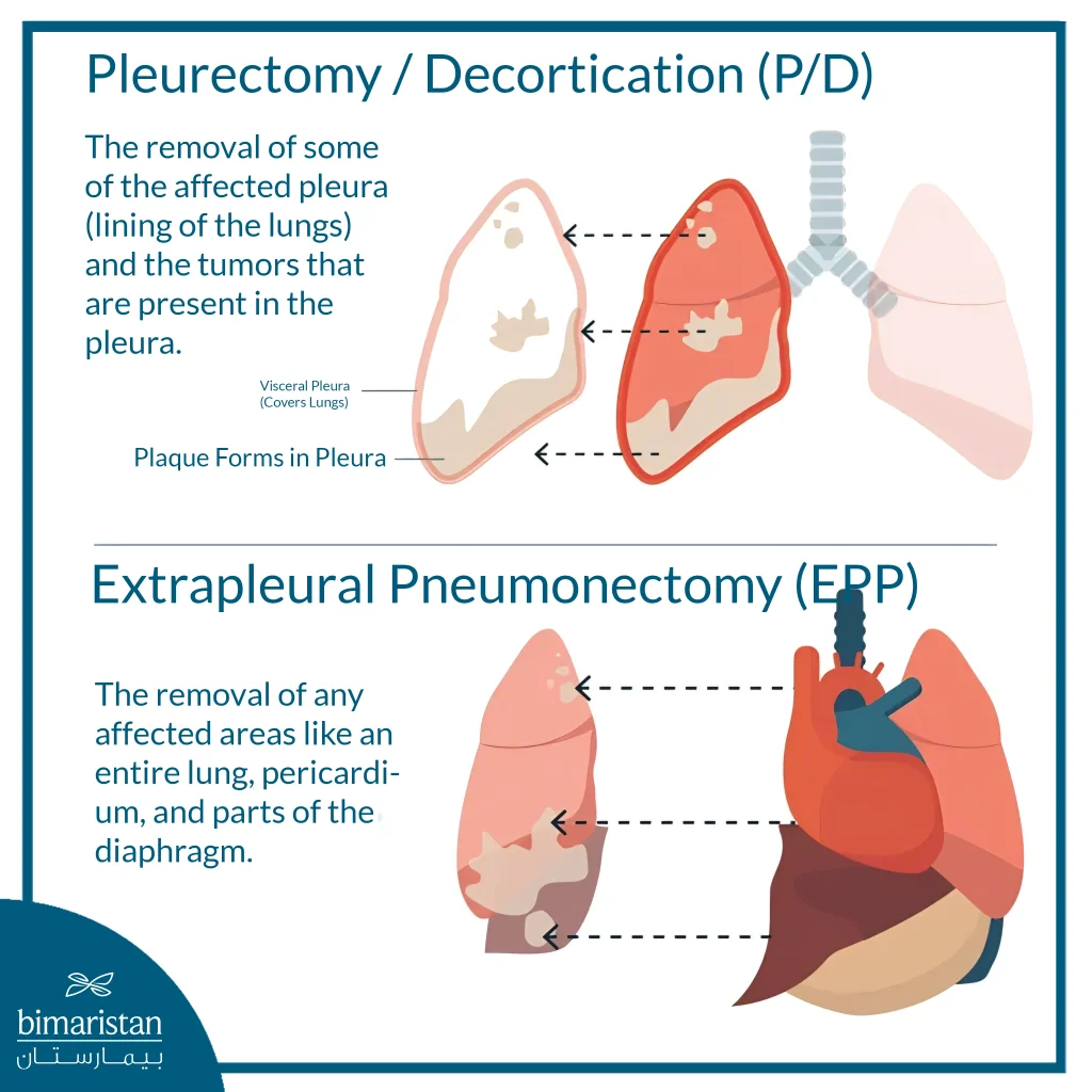 Mesothelioma: Causes, Symptoms, Diagnosis, And Treatment Options 5 Illustration Showing Mesothelioma Lung Surgeries Including Pleurectomy And Extrapleural Pneumonectomy