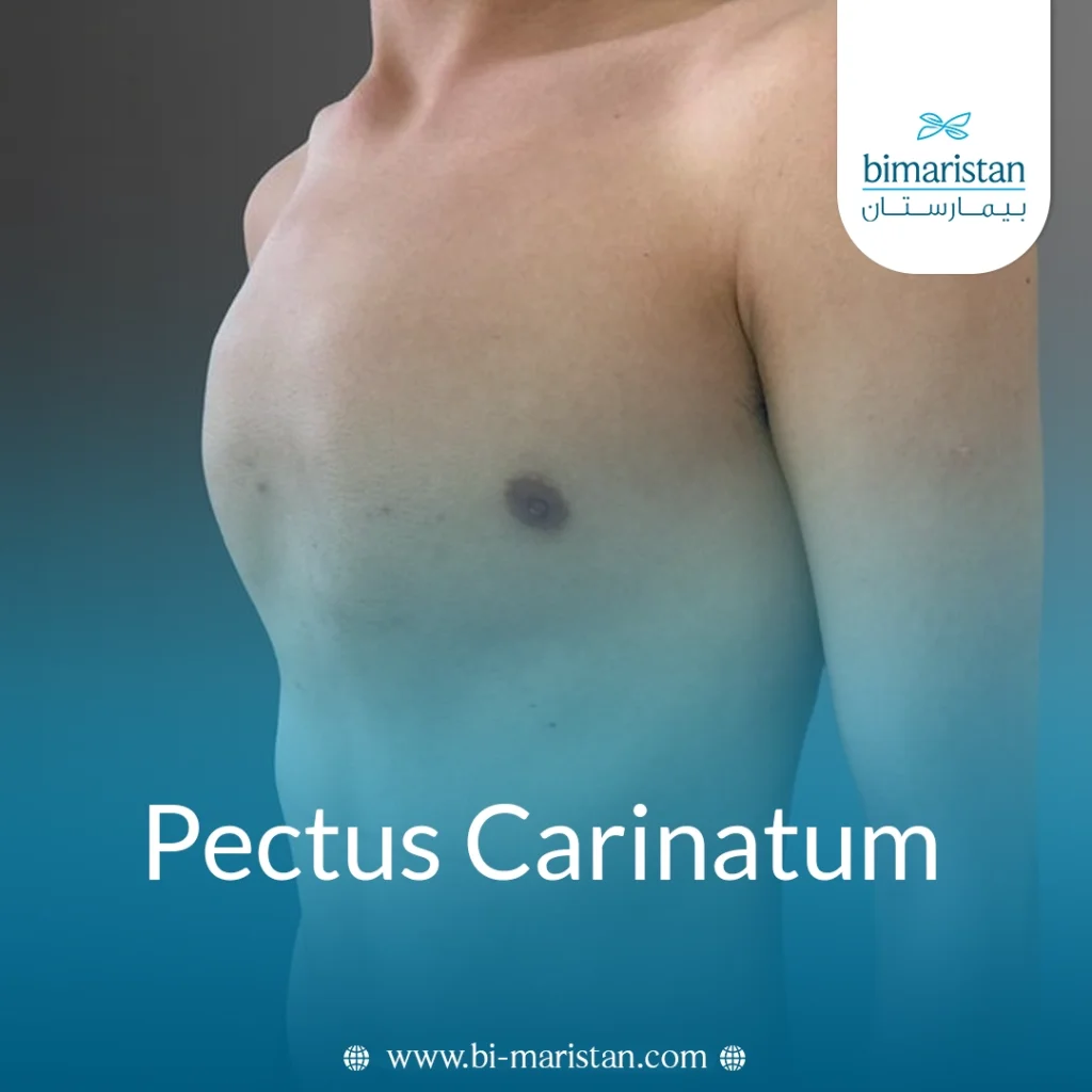Pectus Carinatum