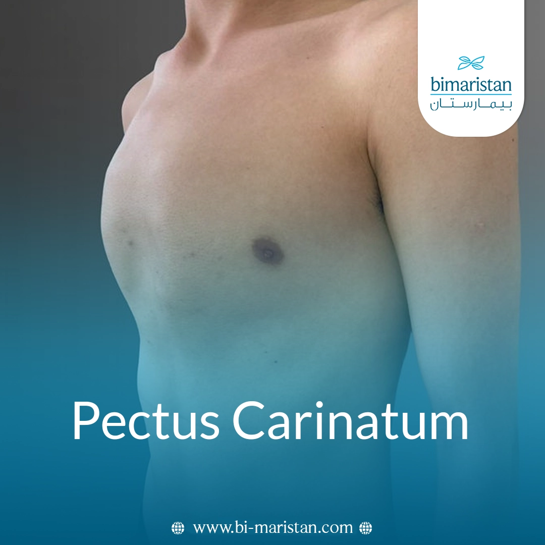 Pectus Carinatum