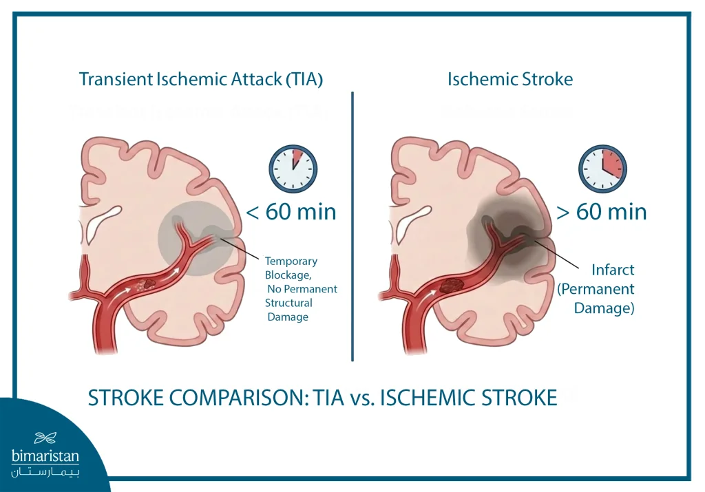 Transient Ischemic Attack: Causes, Symptoms, And Treatment Options 5 The Difference Between A Transient Ischemic Attack (Tia) And An Ischemic Stroke