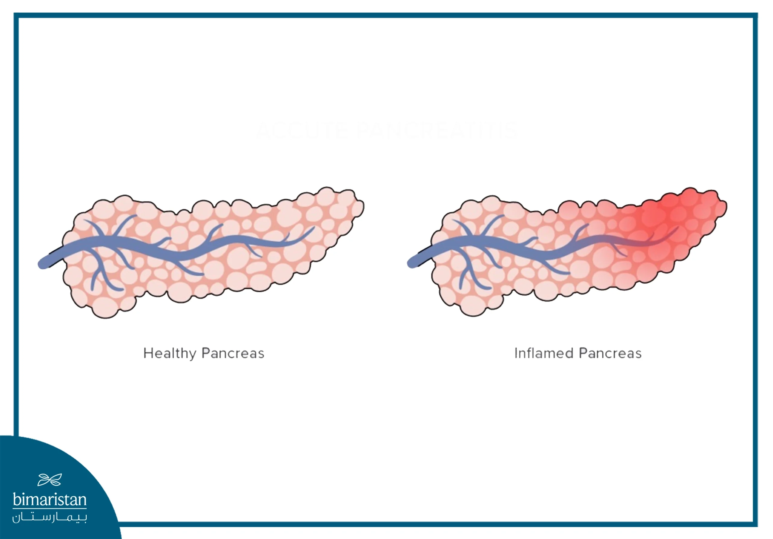 A Diagram Comparing A Healthy Pancreas To Acute Pancreatitis