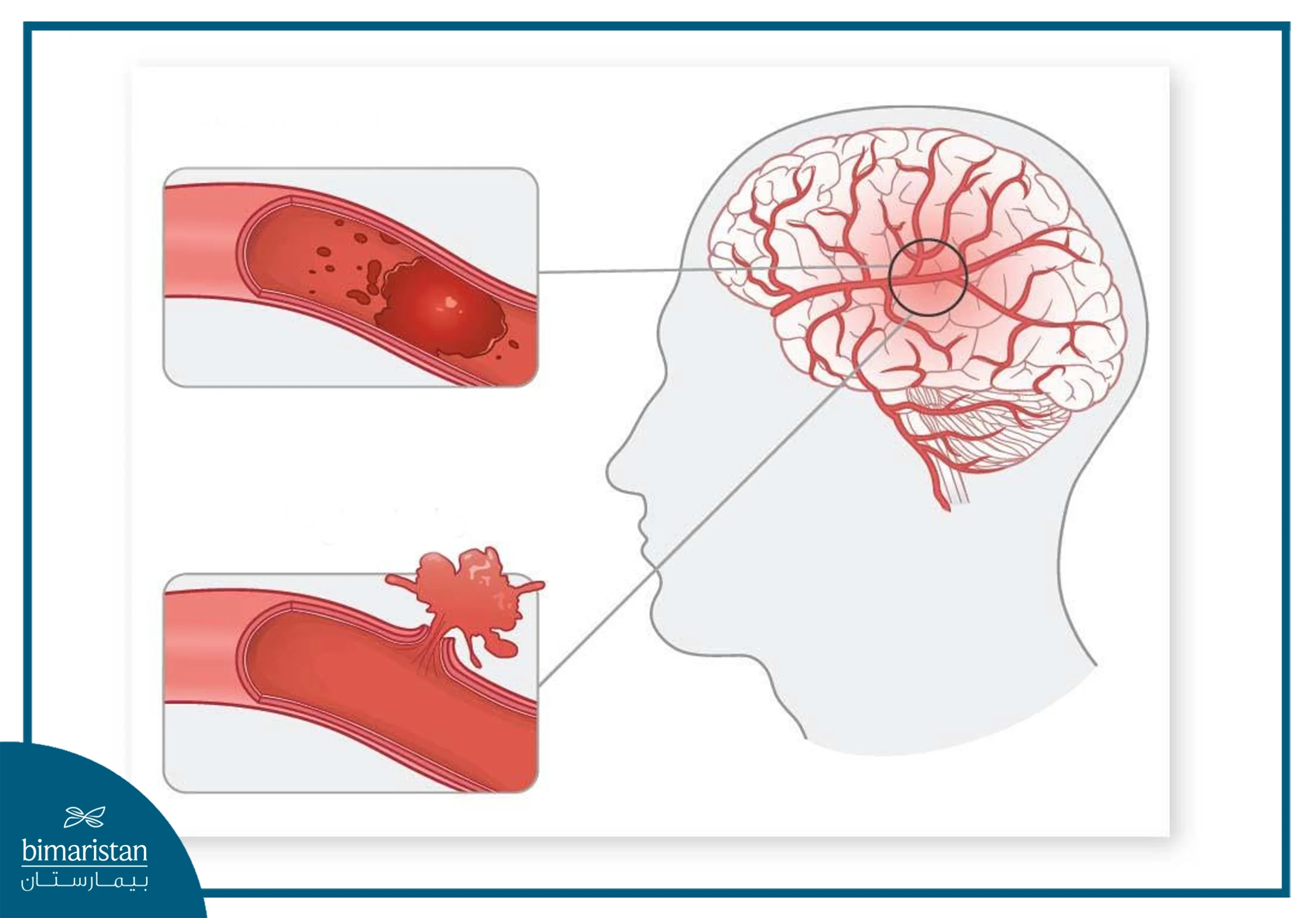 A Diagram Comparing Different Types Of Strokes