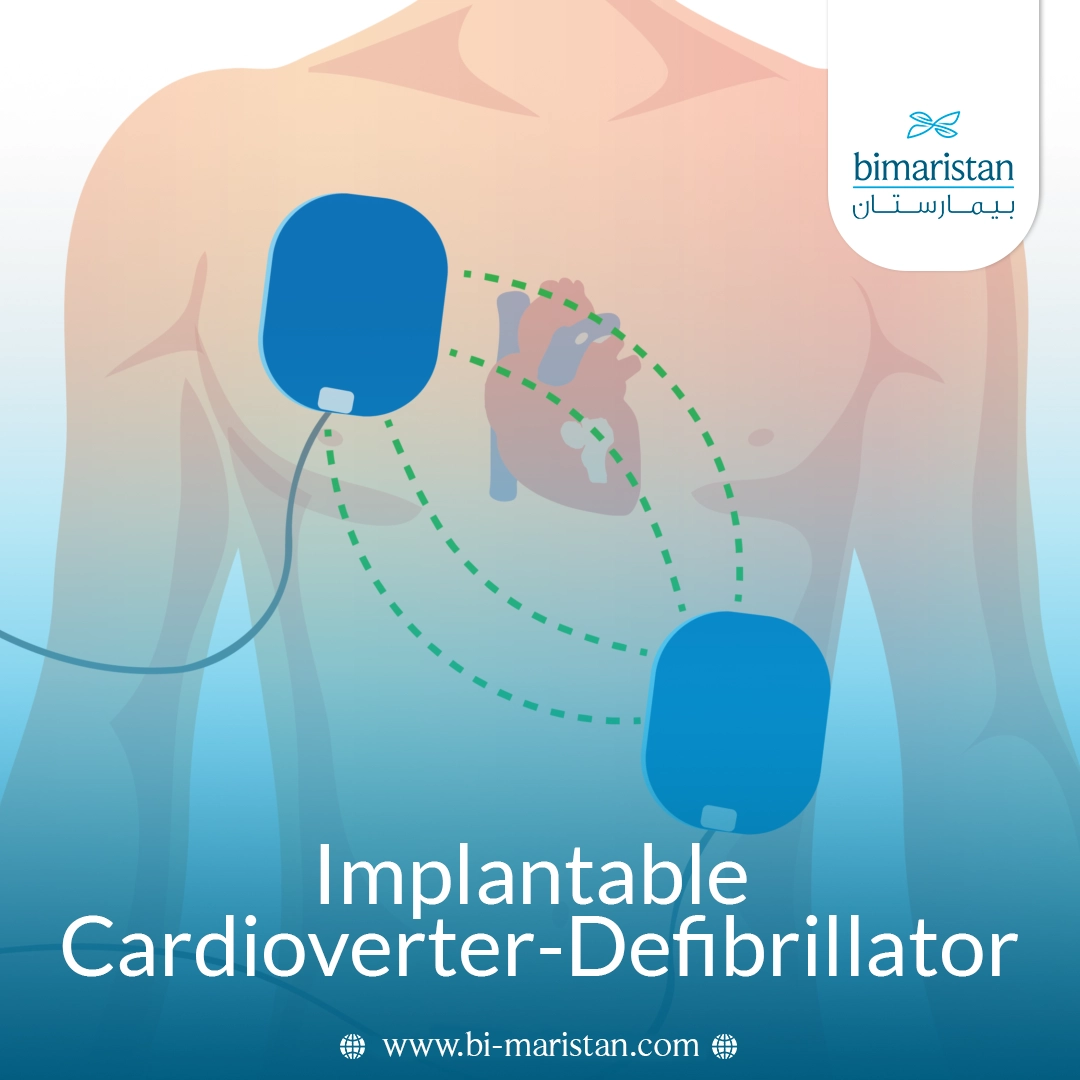 Implantable Cardioverter-Defibrillator