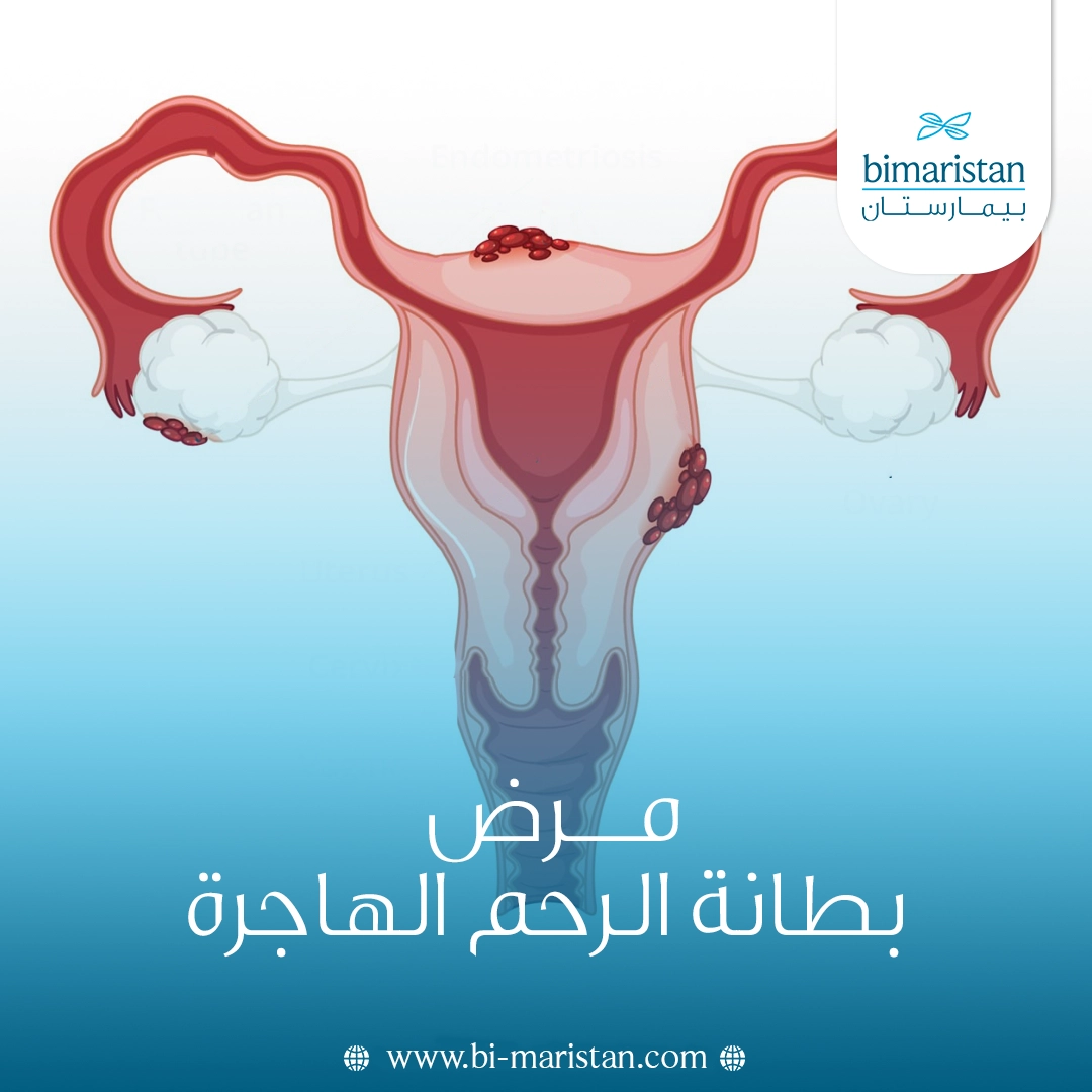 مرض بطانة الرحم الهاجرة