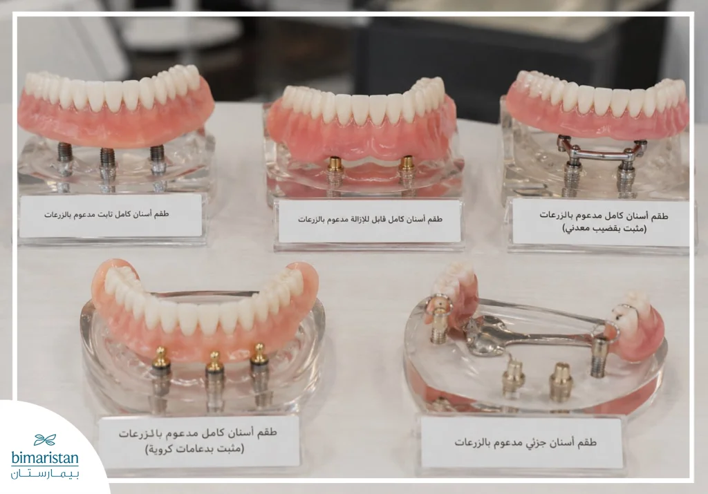أنواع أطقم الأسنان الكاملة والجزئية ذات الزرعات