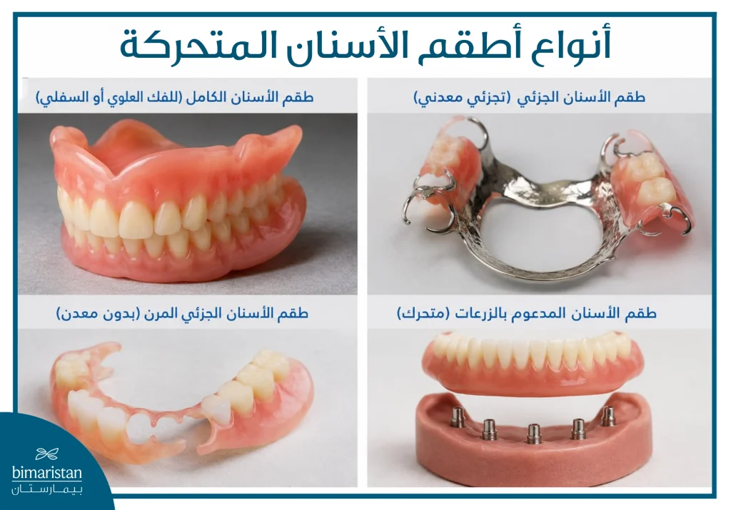 أنواع أطقم الأسنان المتحركة