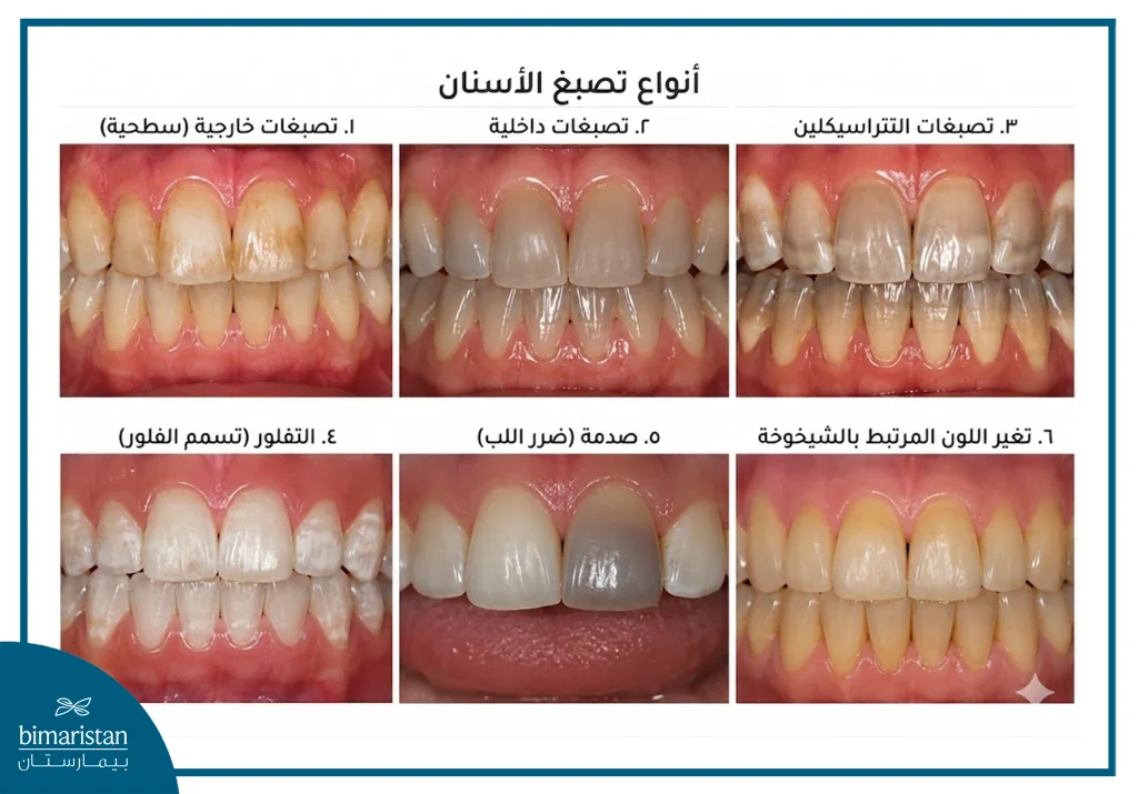 الأنواع المختلفة لتصبغات الأسنان