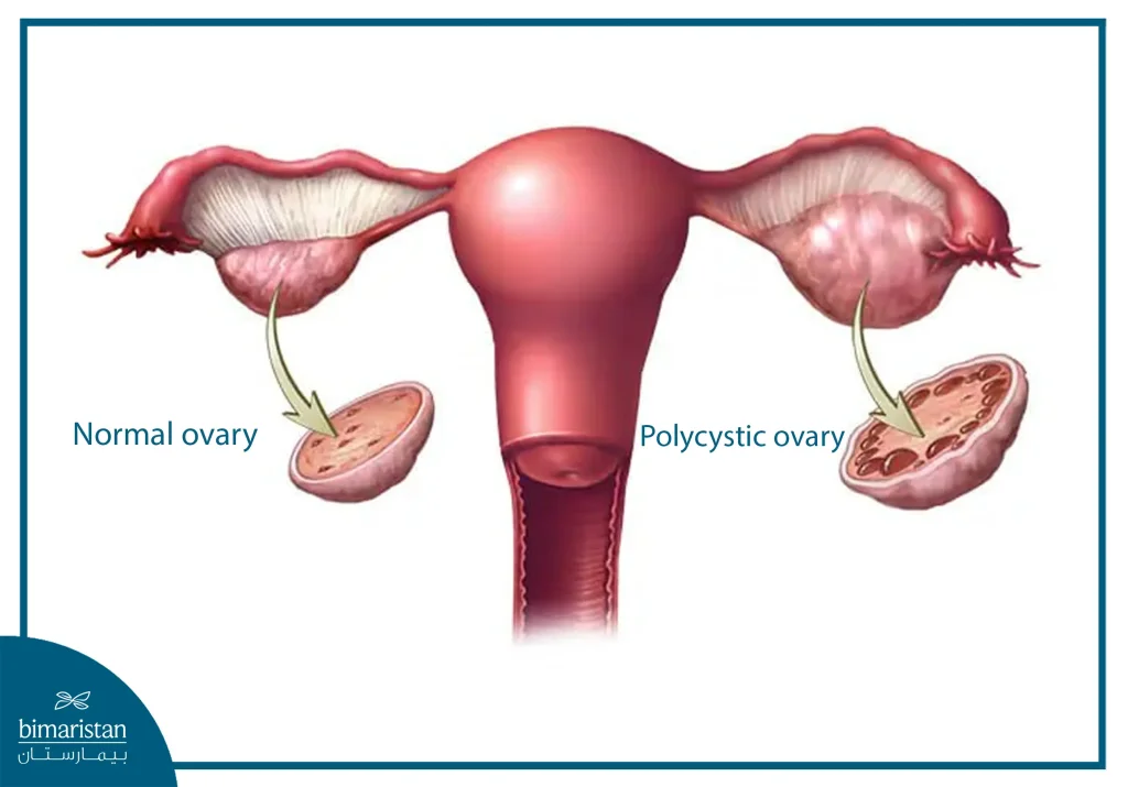 Comparison Of A Normal Ovary And A Polycystic Ovary (Pcos). The Normal Ovary Cross-Section Shows Uniformly Scattered Small Follicles. In Contrast, The Polycystic Ovary Cross-Section Reveals Multiple Small, Peripherally Located Cysts, Leading To Ovarian Enlargement
