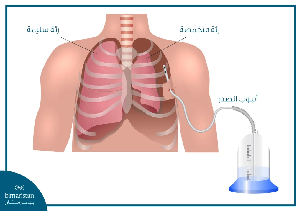 رسم توضيحي لعلاج استرواح الصدر باستخدام أنبوب صدر لتصريف الهواء وإعادة تمدد الرئة