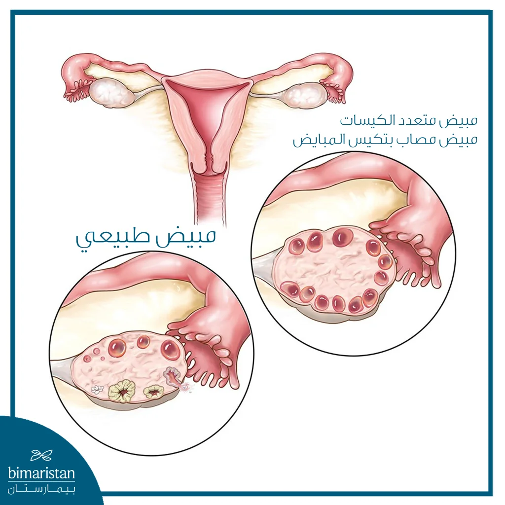 من Pcos إلى Pmos: لماذا تغيّر اسم متلازمة تكيس المبايض؟ 3 رسم طبي يقارن بين المبيض الطبيعي والمبيض المصاب بمتلازمة تكيس المبايض مع إظهار الجريبات الصغيرة المتعددة داخل المبيض