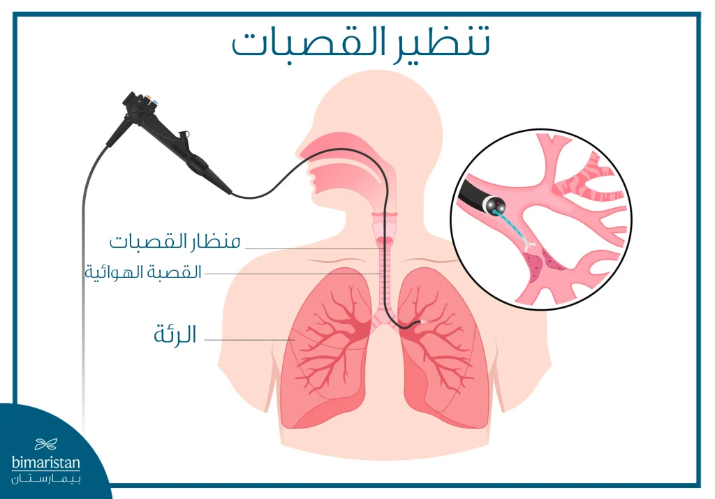 رسم طبي يوضح تنظير القصبات باستخدام منظار مرن داخل القصبة الهوائية والرئتين