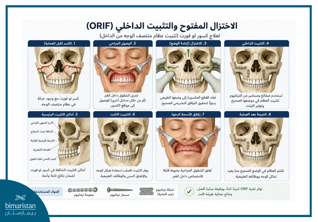 صورة توضح خطوات عملية الاختزال المفتوح مع التثبيت الداخلي (Orif)