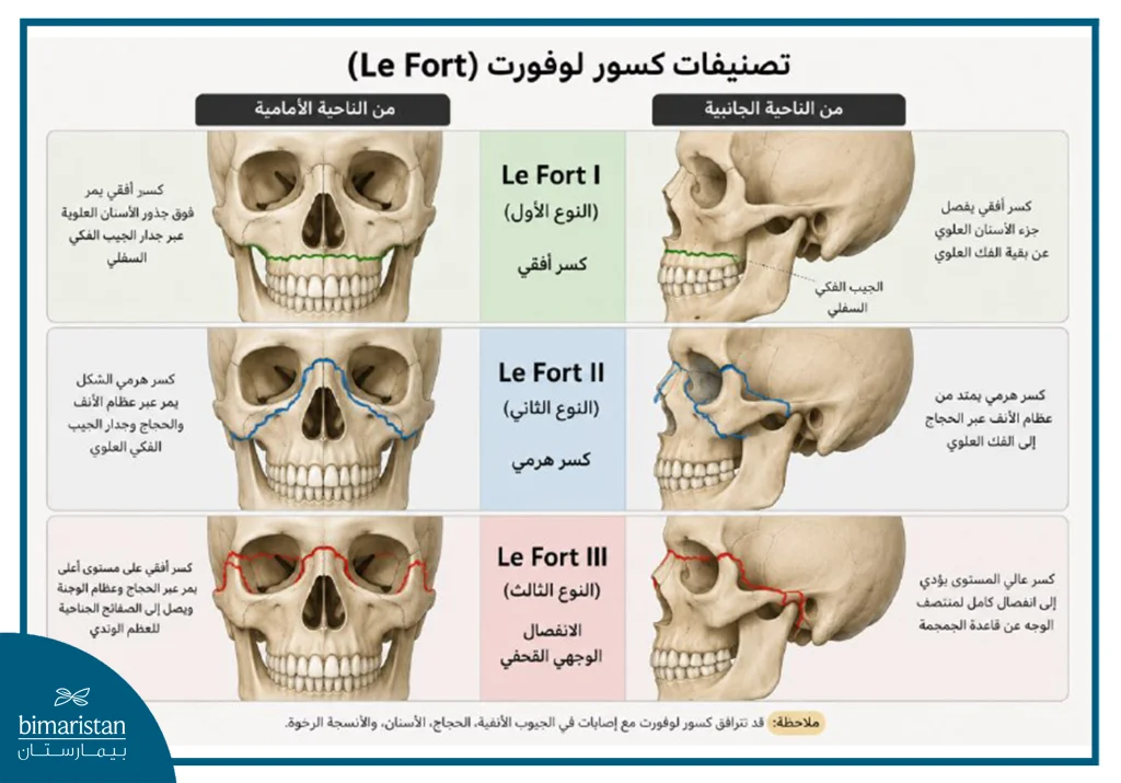 صورة توضيحية لكسور الوجه حسب تصنيف لو فورت