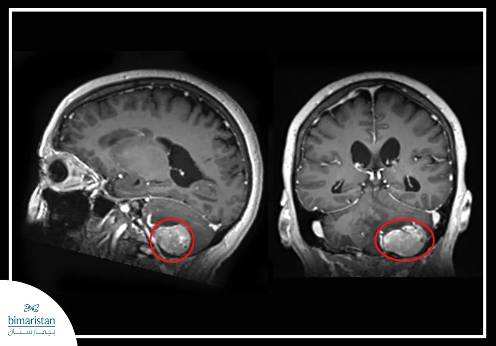 علاج أورام المخيخ: طرق متقدمة وأحدث الأساليب الطبية 11 صورة شعاعية تُظهر ورماً في المخيخ