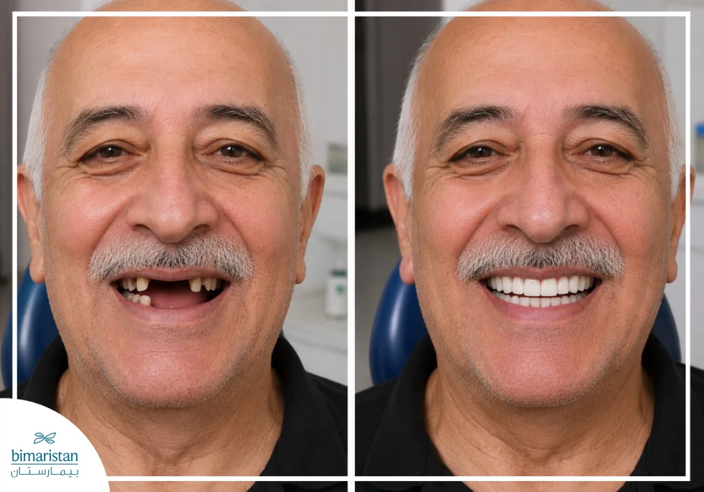 صورة لأسنان مريض قبل وبعد تركيب طقم الأسنان المتحرك