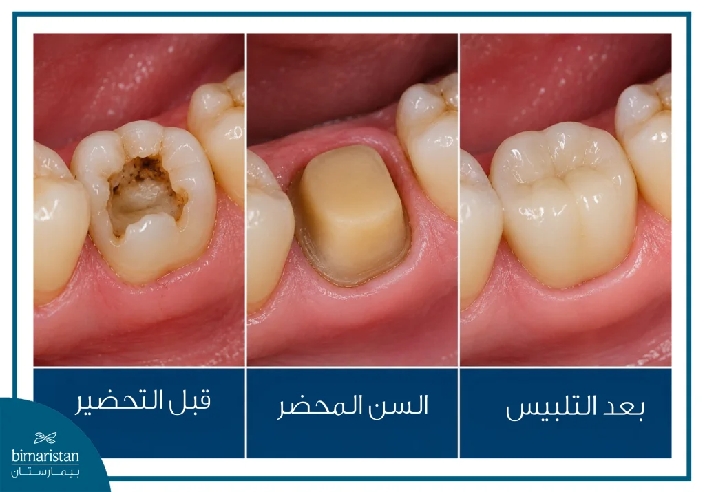 مراحل السن المتخلفة السن قبل التحضير والسن المحضر والسن بعد التلبيس