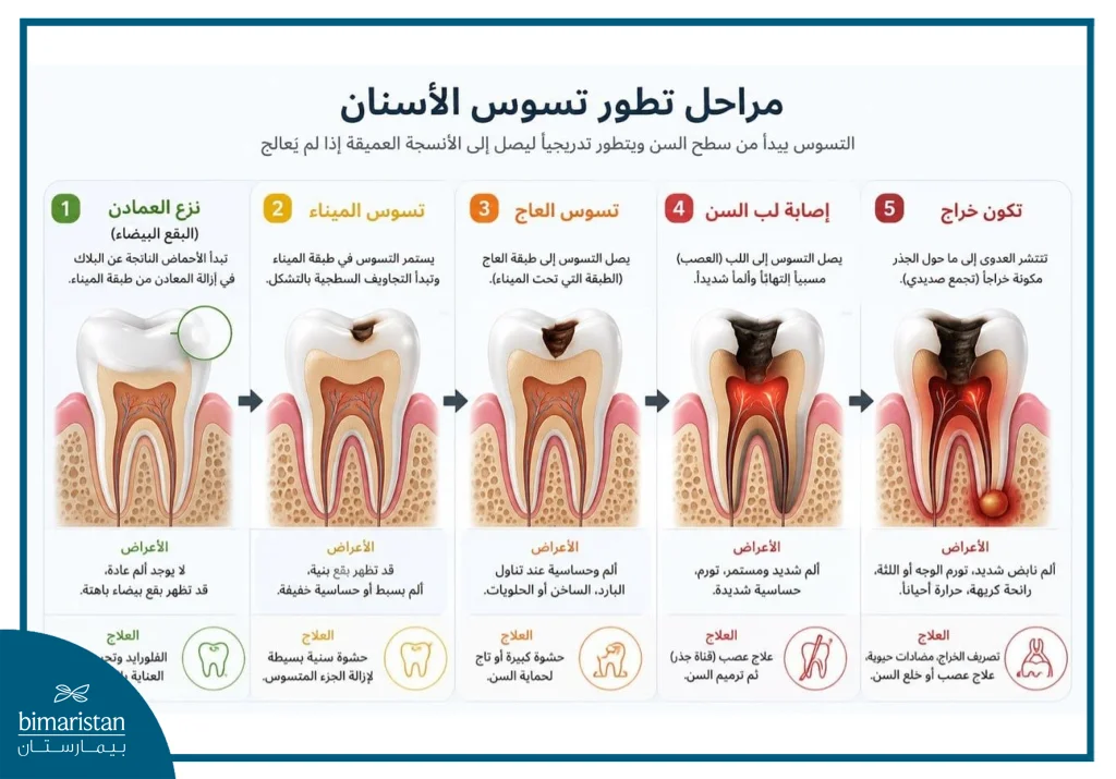 مراحل تطور تسوس الأسنان