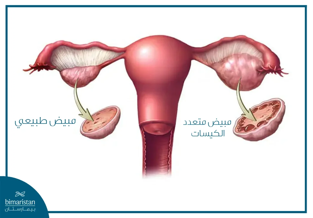 علاج متلازمة تكيس المبايض في تركيا: الخيارات الطبية وأحدث التقنيات 3 مقارنة بين مبيض طبيعي ومبيض متعدد الكيسات (متلازمة تكيس المبايض). يُظهر المقطع العرضي للمبيض الطبيعي جريبات صغيرة متناثرة بشكل موحد. بينما يكشف المقطع العرضي للمبيض متعدد الكيسات عن كيسات صغيرة متعددة تقع في المحيط، مما يؤدي إلى تضخم المبيض.