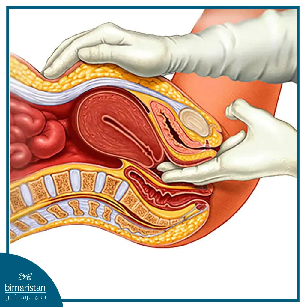 An Anatomical Illustration Showing A Bimanual Pelvic Examination, Used To Assess The Uterus And Pelvic Organs Through Vaginal And Abdominal Palpation To Evaluate Size, Position, Tenderness, Or Masses.