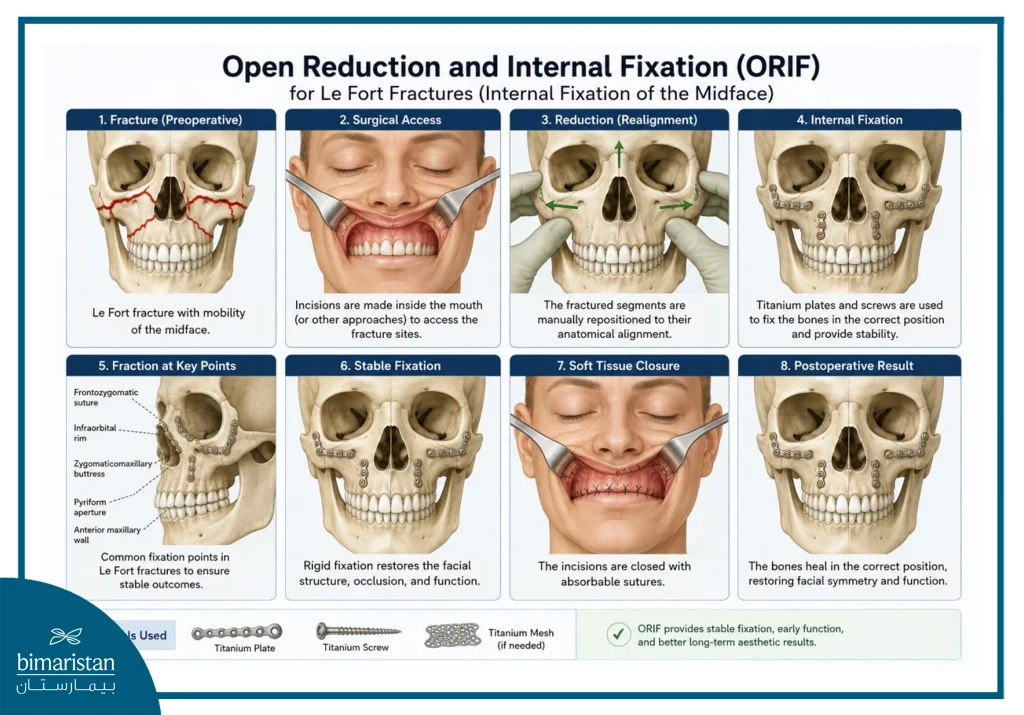 An Image Illustrating The Steps Of Open Reduction And Internal Fixation (Orif).