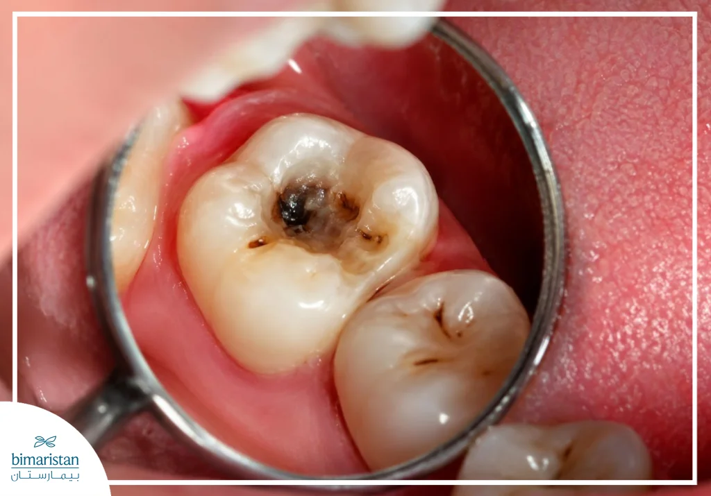 An Image Showing A Tooth Affected By Dental Caries.