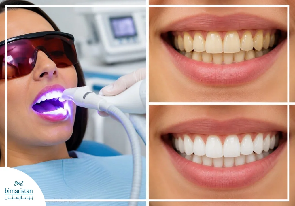 Before And After Laser Teeth Whitening