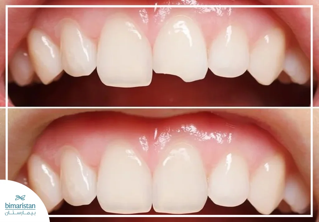 Fractured Tooth Treatment: Causes, Diagnosis, And Treatment Options 3 Before And After Treatment Of A Broken Tooth.