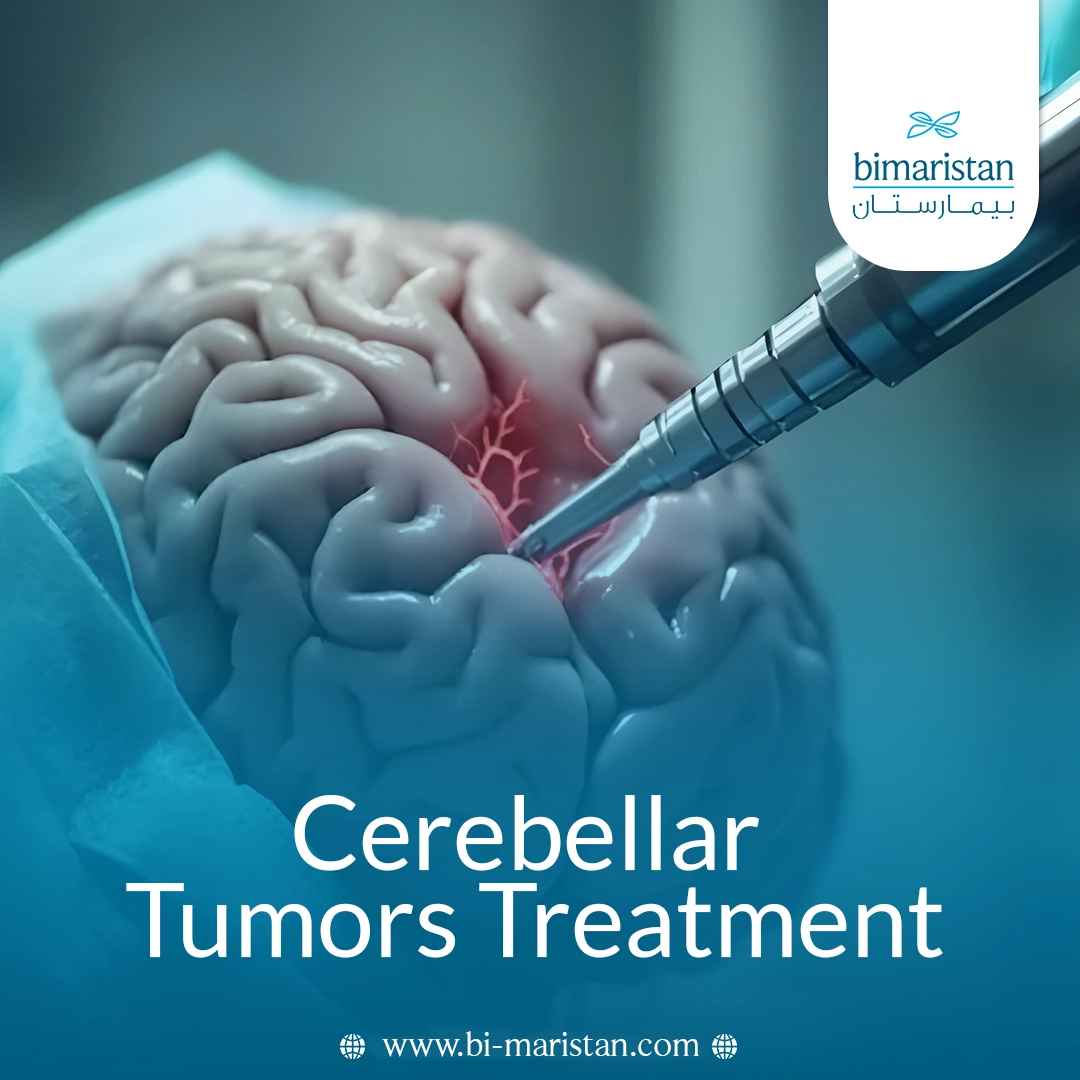 Cerebellar Tumors Treatment