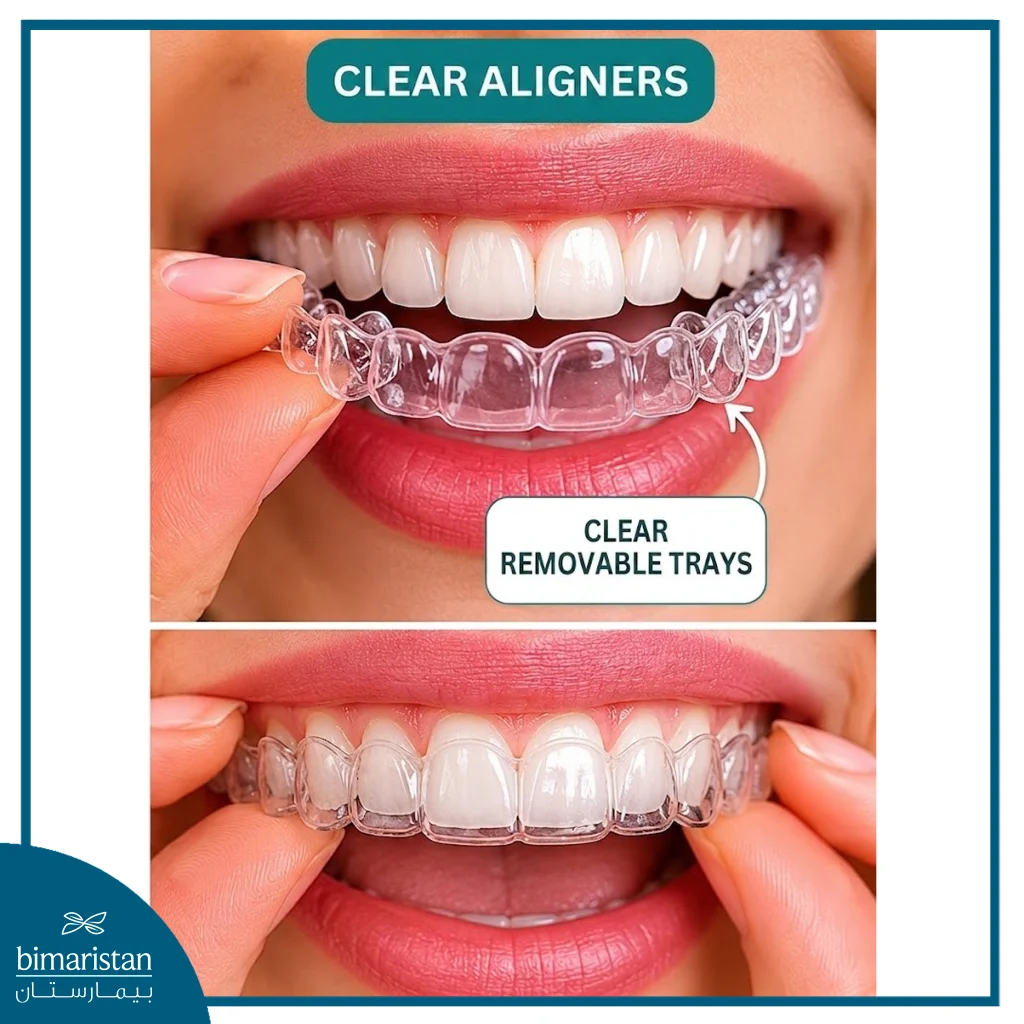 Clear Removable Aligners