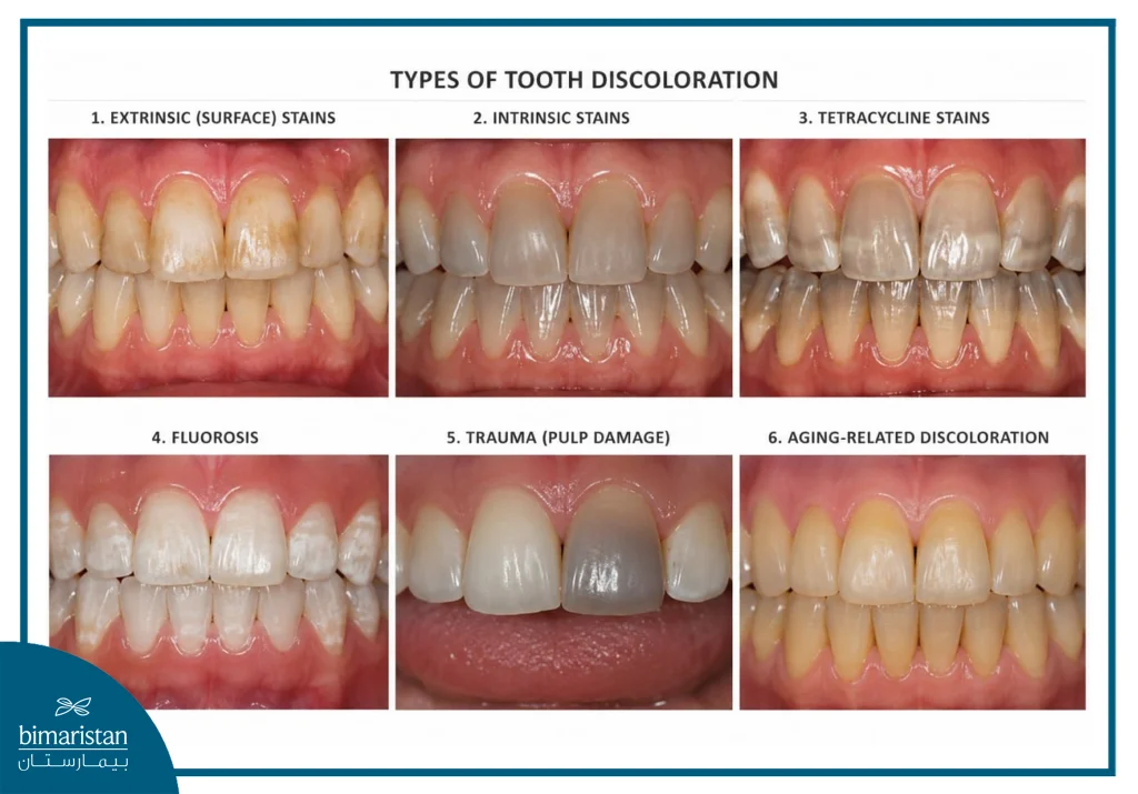Different Types Of Tooth Discoloration