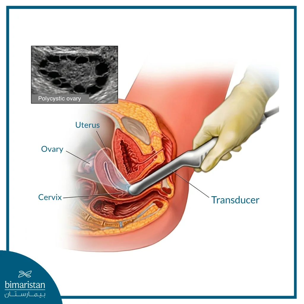 Illustration Of A Transvaginal Ultrasound Showing The Uterus, Ovary, And Cervix, With The Appearance Of A Polycystic Ovary Copy