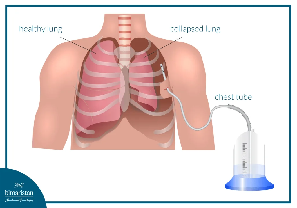 Illustration Of Pneumothorax Treatment Using A Chest Tube To Drain Air And Re-Expand The Lung