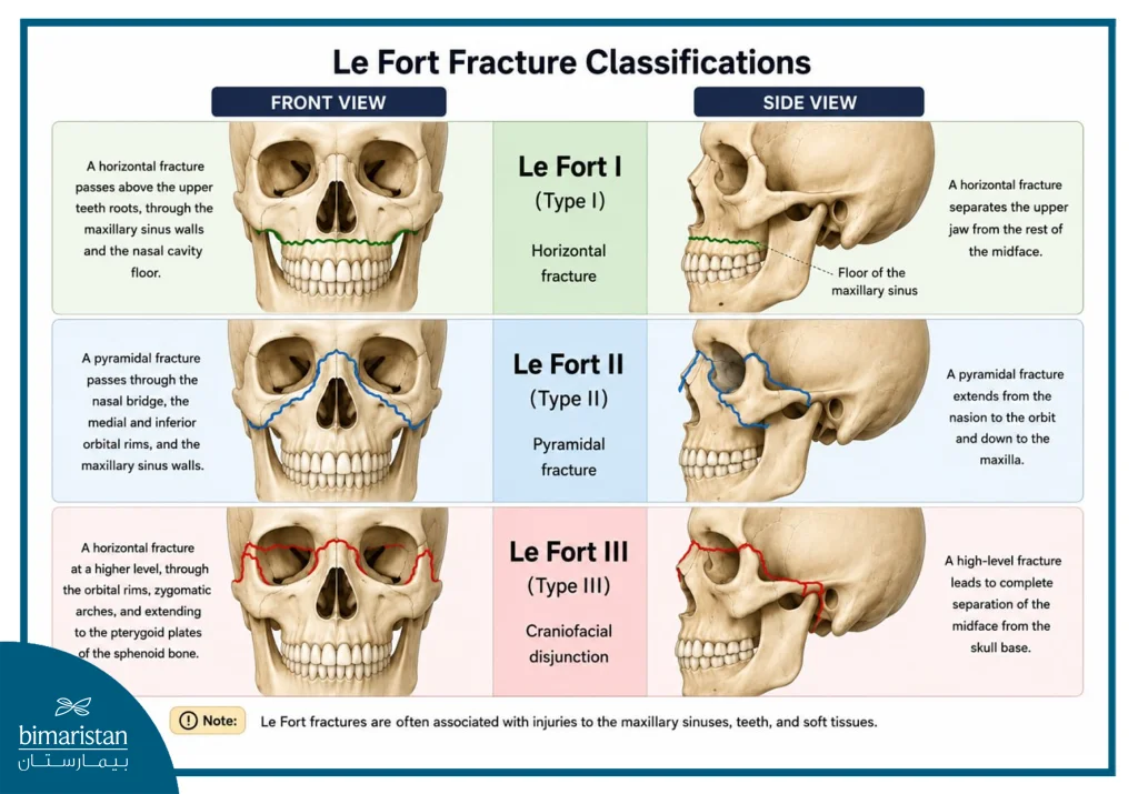 Illustrative Image Of Facial Fractures According To The Le Fort Classification.