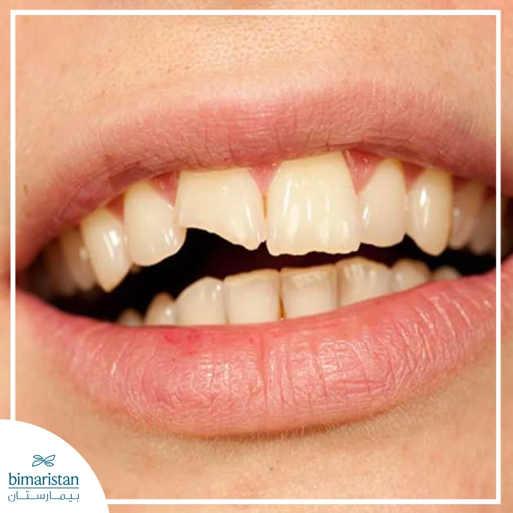 Fractured Tooth Treatment: Causes, Diagnosis, And Treatment Options 2 Image Showing A Fractured Incisor Tooth.