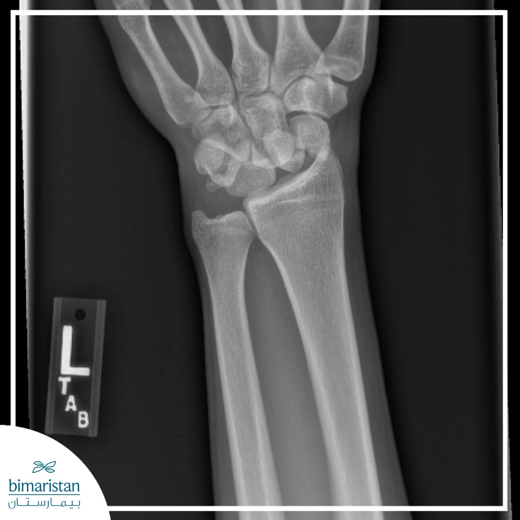 Left Wrist X-Ray Showing Displaced Distal Radius Fracture And Carpal Alignment, Used For Accurate Diagnosis Of Wrist Trauma And Injury.