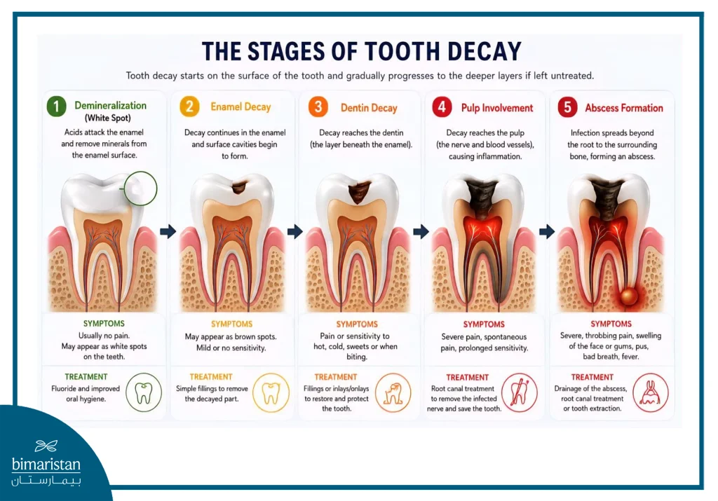 Stages Of Dental Caries Development