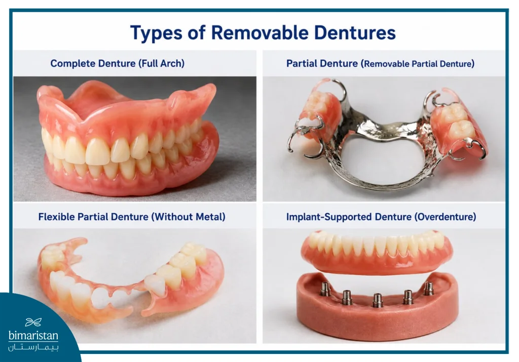 Types Of Removable Dentures