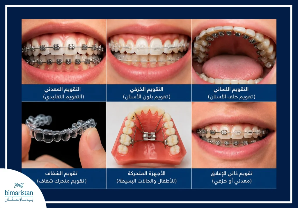 Types Of Orthodontic Treatment