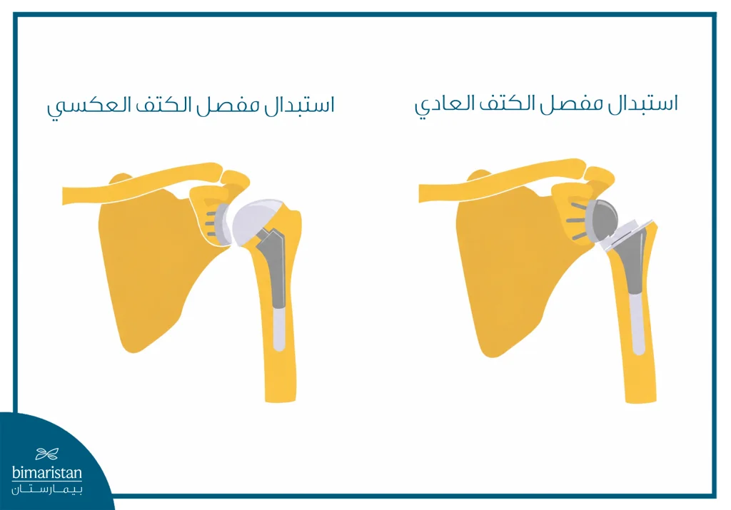 أنواع مفاصل الكتف الصناعية في تركيا 3 الفرق بين استبدال مفصل الكتف العادي والعكسي
